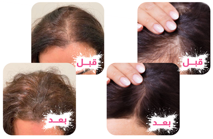 فرشاة علاج تساقط الشعر